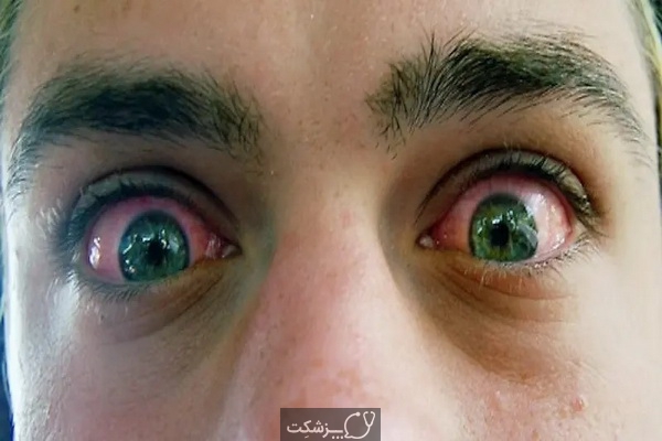 علت قرمزی چشم | پزشکت