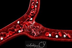 کم خونی داسی شکل در کودکان | پزشکت