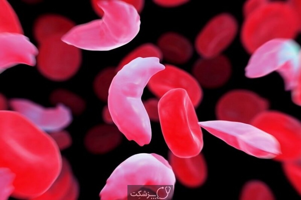 کم خونی داسی شکل در کودکان | پزشکت