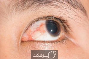 عوارض بیماری کرون در چشم | پزشکت