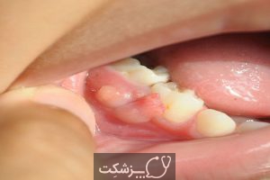 آبسه دندان در کودکان | پزشکت