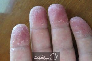 پوسته پوسته شدن انگشتان دست | پزشکت