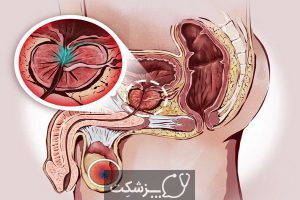 سرطان آلت تناسلی مرد | پزشکت