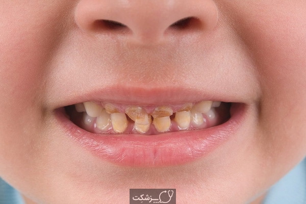 سیاه و یا زرد شدن دندان در کودکان 6 | پزشکت