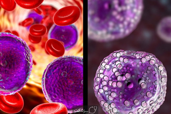 5 تفاوت عمده بین سرطان خون و لنفوم 4 | پزشکت