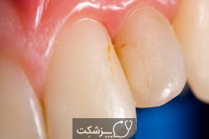 سیاه و یا زرد شدن دندان در کودکان 2 | پزشکت