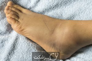 ورم مچ پا، از 12 علل احتمالی تا درمان آنها | پزشکت