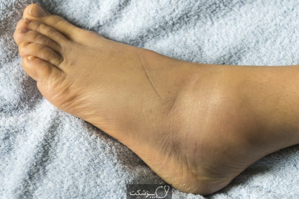 ورم مچ پا، از 12 علل احتمالی تا درمان آنها | پزشکت