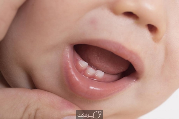 علائم دندان درآوردن کودکان و مراقبت آنها | پزشکت