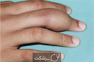 علت ورم انگشت دست چيست؟ | پزشکت