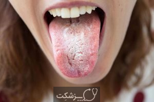 10 درمان خانگی برای آفت دهان | پزشکت