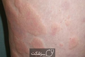 کهیر مزمن، علائم + علل و راهکارهای درمانی آن | پزشکت