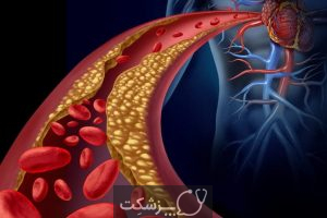 ایسکمی قلبی چیست و چگونه درمان می شود؟ | پزشکت