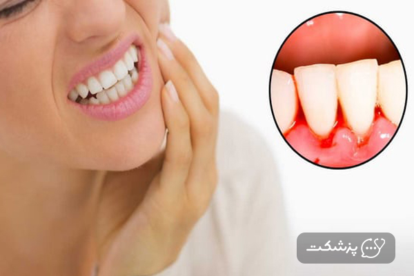 زن جوان با خونریزی لثه در بارداری