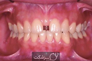 دیاستما یا فاصله بین دندان ها چگونه درمان می شود؟ | پزشکت