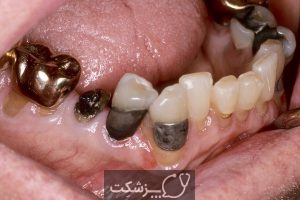 مشکلات دندانپزشکی در سالمندان | پزشکت