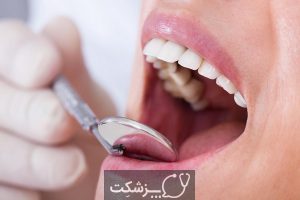 موکوسل دهانی چیست؟ | پزشکت