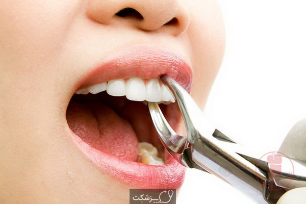 رژیم غذایی مناسب بعد از کشیدن دندان | پزشکت