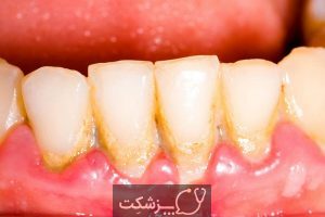 راه های از بین بردن پلاک دندان در خانه | پزشکت