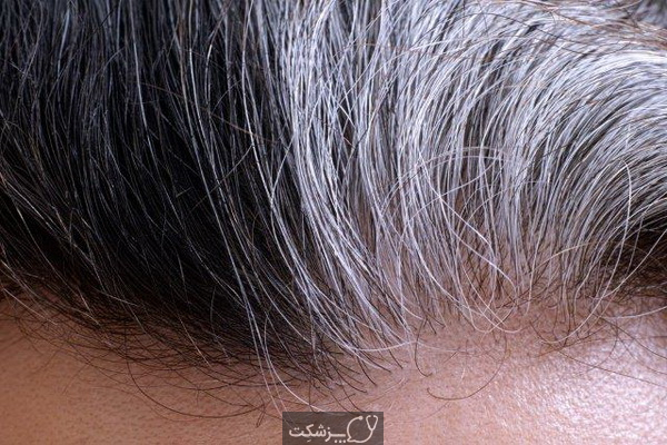 شایع ترین علل تکه های سفید مو کدامند؟ | پزشکت