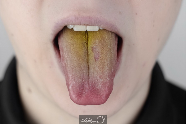 زرد شدن زبان نشان دهنده چیست؟ | پزشکت