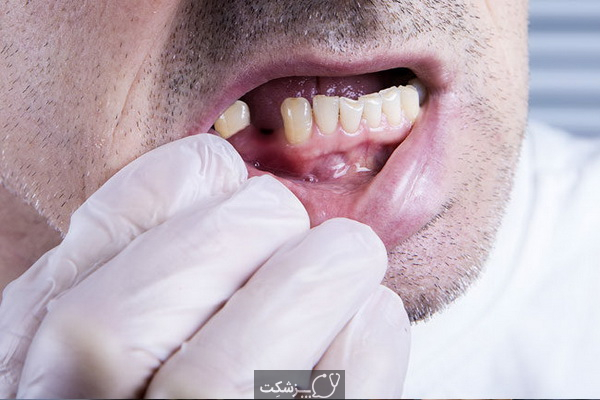 تاثیر کرونا بر دهان و دندان | پزشکت