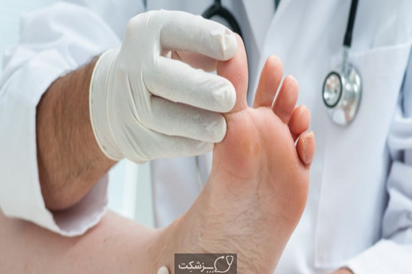 شکستگی انگشت پا چیست و چگونه درمان می شود؟ | پزشکت