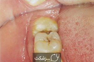 خرد شدن دندان های عقل و راهکارهای آن | پزشکت