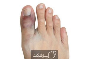 شکستگی انگشت پا چیست و چگونه درمان می شود؟ | پزشکت