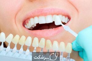 روکش دندان چیست و انواع آن کدامند؟ | پزشکت
