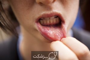شایع ترین علل خونریزی زبان چیست؟ | پزشکت