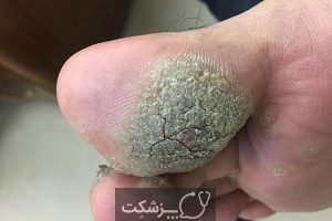  زگیل کف پا چگونه درمان می شود؟ | پزشکت