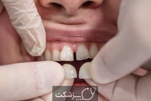 روکش دندان چیست و انواع آن کدامند؟ | پزشکت