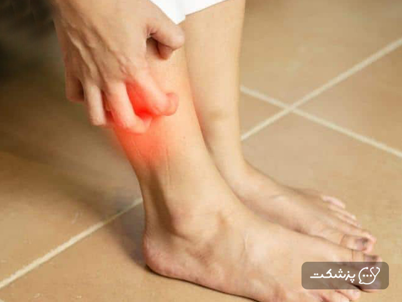 علت خارش ساق پا