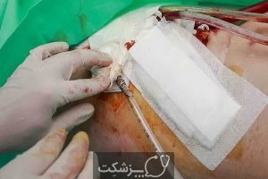 عفونت بعد از جراحی | پزشکت