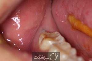 پری کورونیت دندان | پزشکت