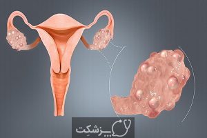 درمان پارگی کیست تخمدان چیست؟ | پزشکت