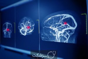 آنژیوگرافی مغزی | پزشکت