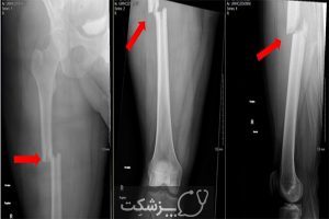 شکستگی استخوان ساق پا | پزشکت