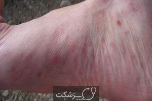 لکه های قرمز کف پا | پزشکت