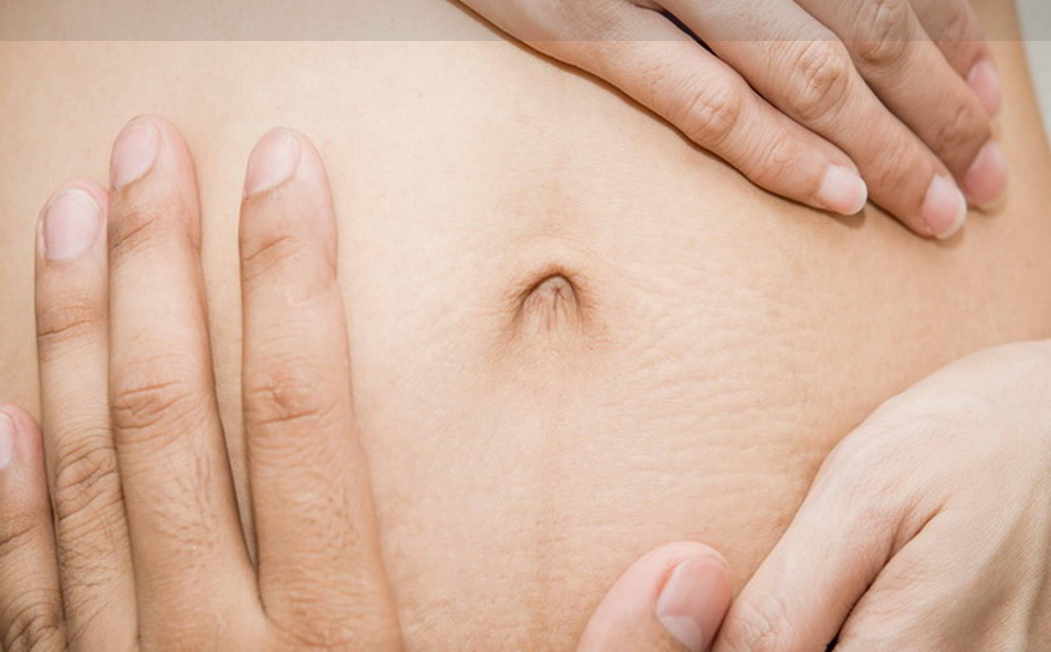 جدا شدن عضلات شکمی در بارداری | پزشکت