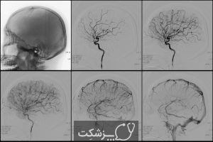 آنژیوگرافی مغزی | پزشکت
