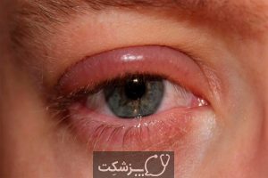 عادات اشتباه آرایشی و خشکی چشم | پزشکت