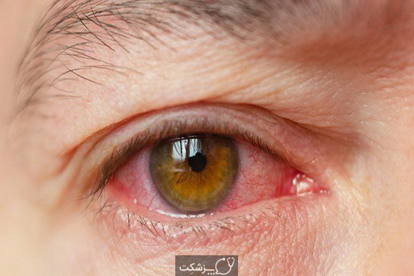 15 علت اصلی خشکی چشم | پزشکت