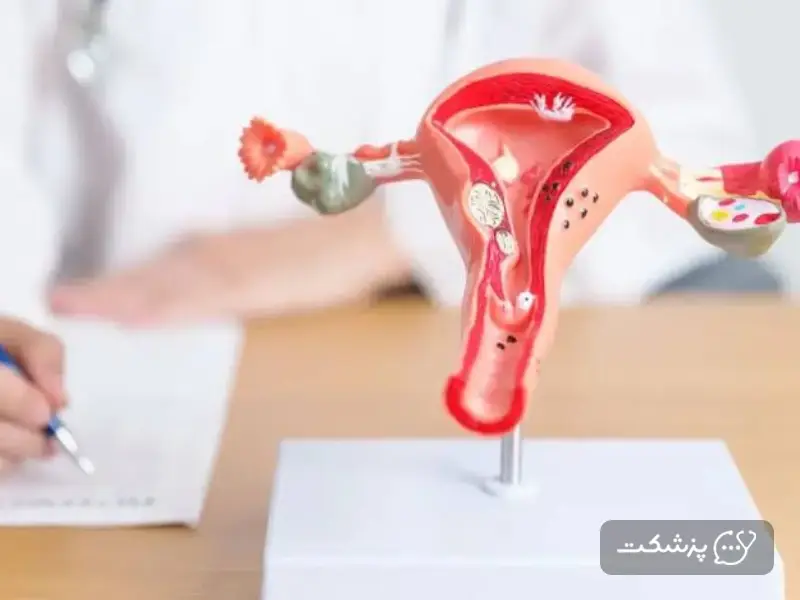 درمان فیبروم بزرگ رحم