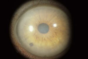 تیمولول چشمی چیست؟ | پزشکت
