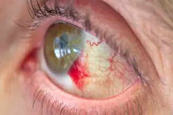 خونریزی چشم | پزشکت