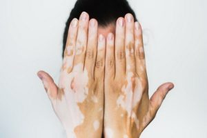 اختلالات رنگدانه پوست چیست؟ | پزشکت