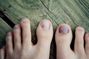 سیاه شدن ناخن پا، علل و راهکارهای درمانی | پزشکت