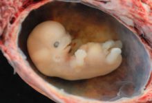 سقط جنین ناقص | پزشکت